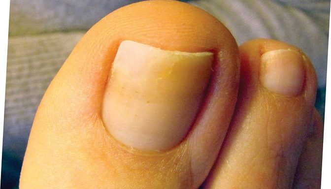Грибок ногтей на ногах: симптомы, первые признаки и причины