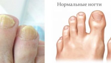 Первые симптомы грибка ногтей на ногах, признаки и лечение