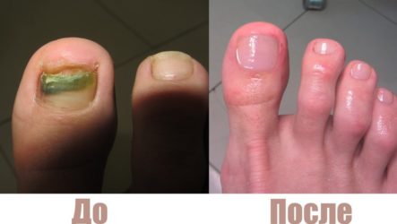 Быстрое лечение грибка ногтей
